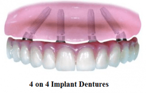 4 on 4 denture