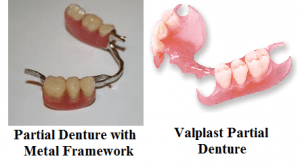 Partial Denture