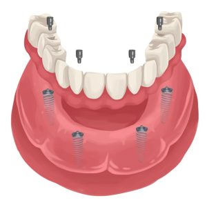 a diagram of implant-supported dentures